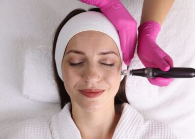What to Expect from RF Microneedling With the Vybe Device