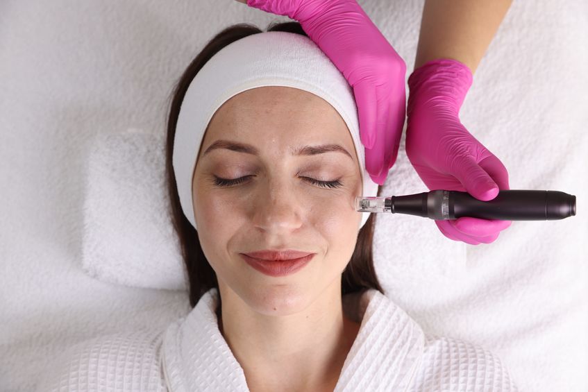 What to Expect from RF Microneedling With the Vybe Device